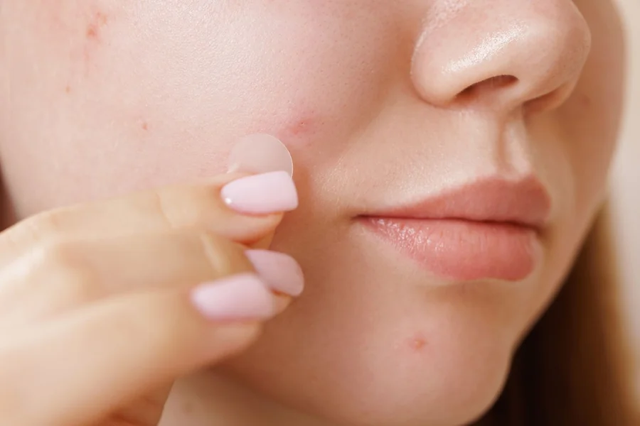 Do Pimple Patches Actually Work? Do Pimple Patches Actually Work?